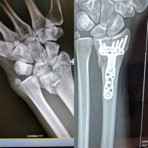 [OC] Broken wrist and repair : r/XRayPorn