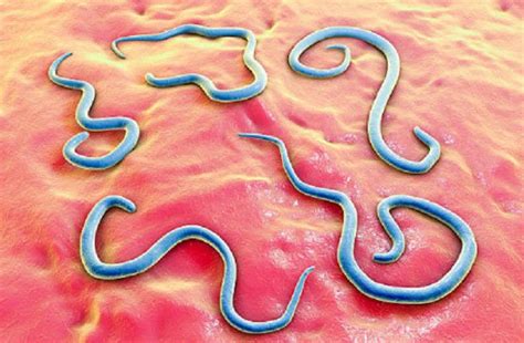 sumbatan usus anak oleh  kg cacing gelang klikdokter