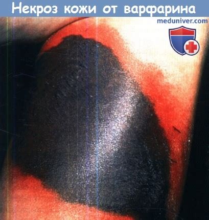 Некроз кожи от антикоагулянта