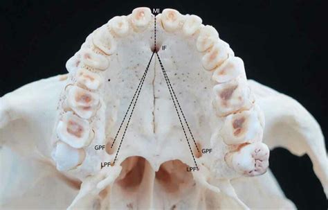 Parameters measurements from various anatomical landmarks to maxilla ...