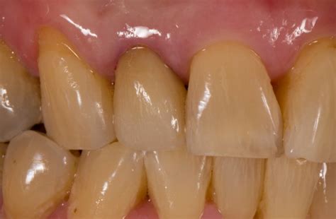 Today's Lateral incisor | CDOCS