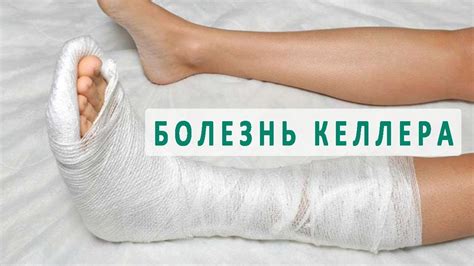 Болезнь Келлера 1 и 2 вида - YouTube