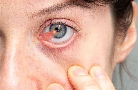 Pterygium Colli Deformity 5