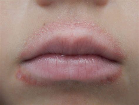 Why Am I Getting White Spots On My Lips - Infoupdate.org
