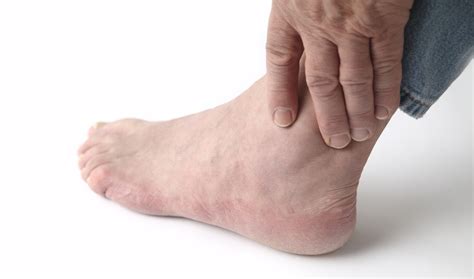 What Is Gout - Causes, Symptoms and Treatment | Live Science