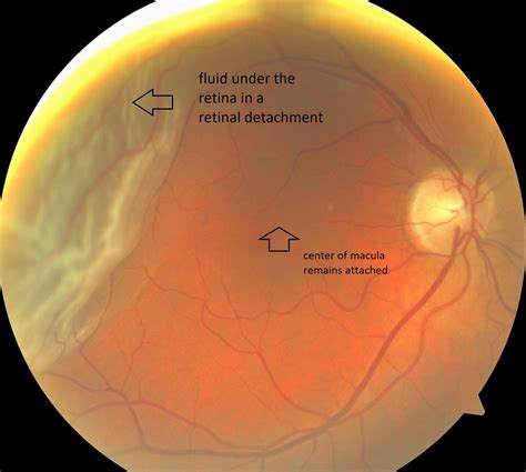 funnel retinal detachment  booker zuniga blog