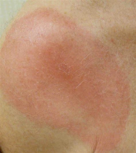 Erythema Migrans