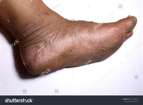 cracked feet  white background stock photo  shutterstock