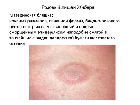 Что такое моллюск на коже у ребенка фото с описанием