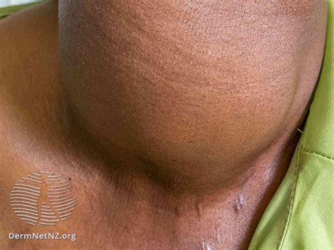 What Cancer Causes Lump In Back Of Neck - Infoupdate.org