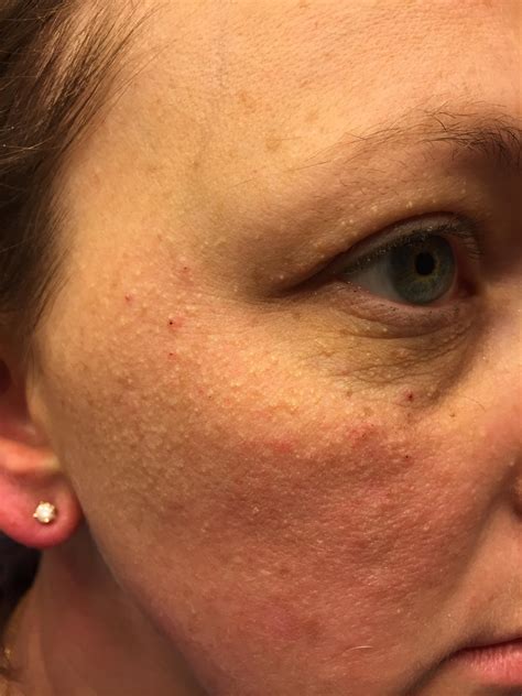 What Causes Calcium Deposits On Skin at Kara Torres blog