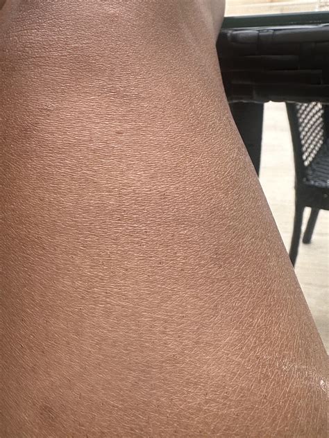 My legs have become so dry. They were not like that before. How can i