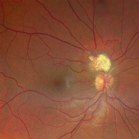 Hamartoma astrocítico retiniano - Retina Club : Retina Club