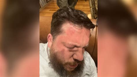 Russian Opposition Figure Leonid Volkov Attacked: Possible Russian ...