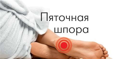 Как лечить пяточную шпору? — Мир Пользы