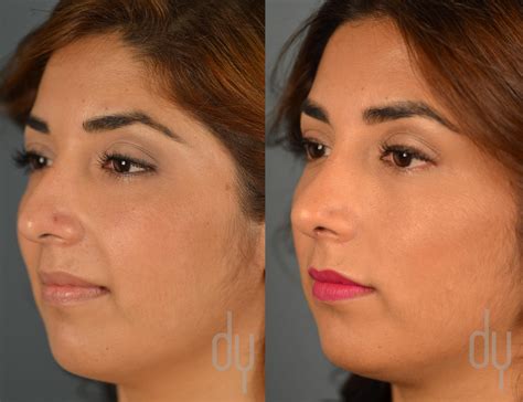 perform  nose job  sandra moody blog