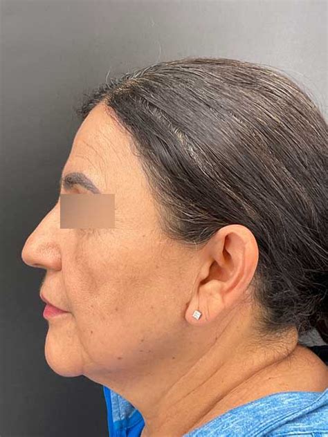 surgical procedures archives resurrect skin md resurrect skin md