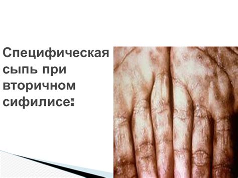 СИФИЛИС презентация, доклад