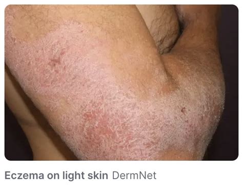 Heat Rash vs. Eczema: What's the Difference? — Uptown Dermatology