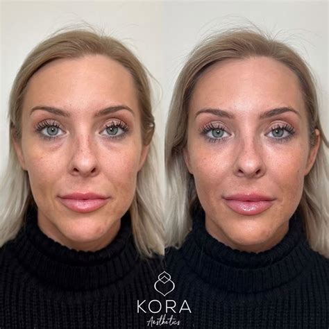 prf ez gel    transformations hubmed