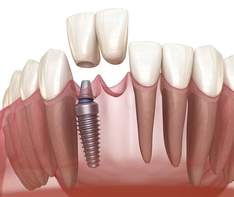 Cantilever bridge implant based, frontal tooth recovery. Medically ...