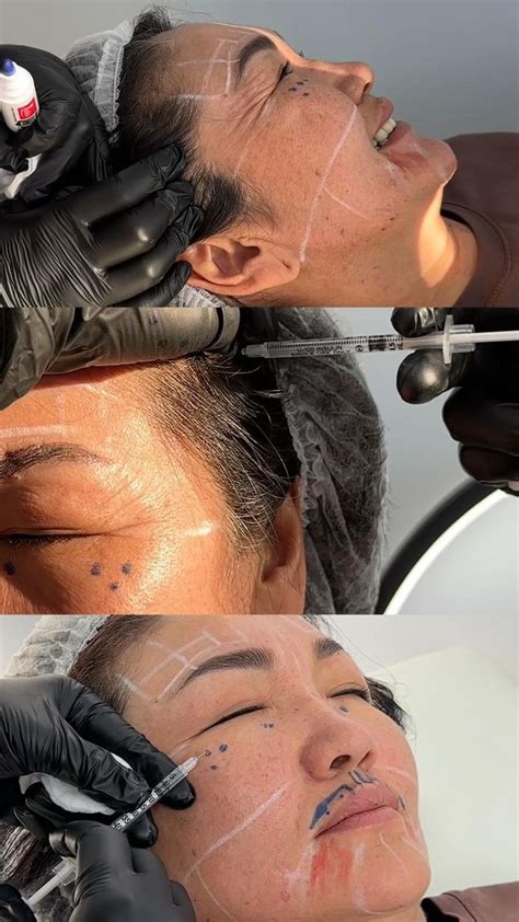 Botox full face in 2024 | Botox, Face, Photo and video