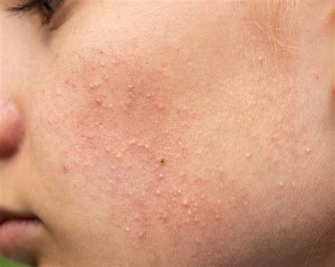 healing closed comedones