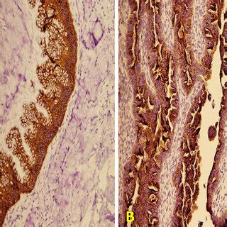 (A) Endometrial mucinous carcinoma showing complex glandular structures ...