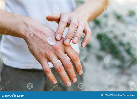 Applying An Emollient To Dry Flaky Skin As In The Treatment Of ...