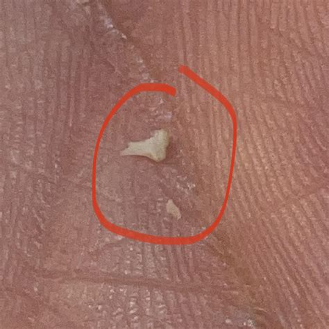 Post-op 4 weeks: Small pieces of tooth falling out from healing gums