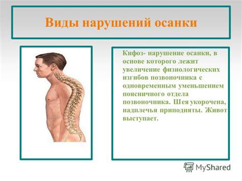 Презентация на тему: "Нарушение осанки у дошкольников. Цели ...