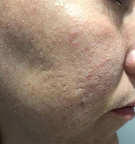 iPixel ablative laser – Cindy Knight Clinic