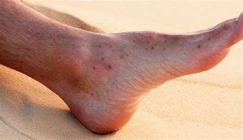 Sand Fleas Bites