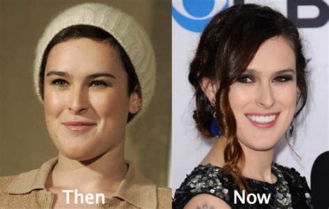 Rumer Willis Plastic Surgery Before and After Photos