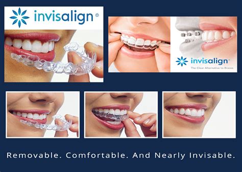 Invisalign — Smile Plant Dental