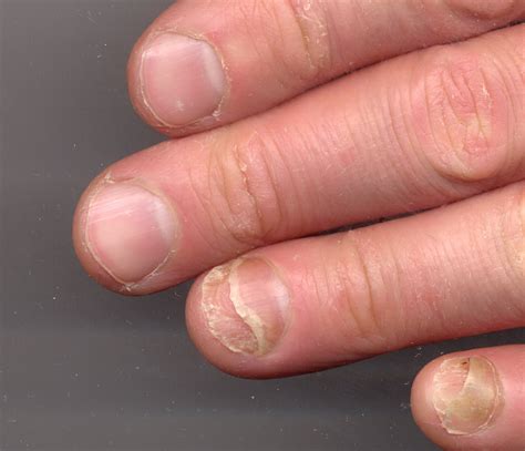 fingernail lifted from nail bed - pictures, photos