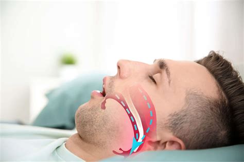 Did You Know Your Dentist Can Help With Sleep Apnea?