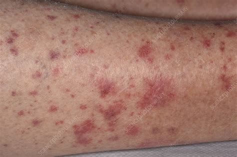 Allergic Vasculitis Rash