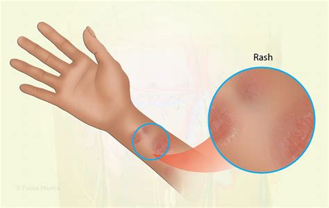 Health Condition : Symptoms, Causes, Treatment and More