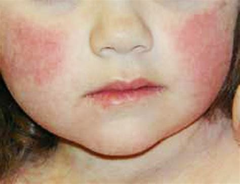 Parvovirus B19: Quinta Malattia - GravidanzaOnline