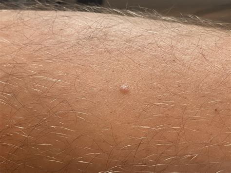 33M with hard bump on shin. Probably developed in the last few months