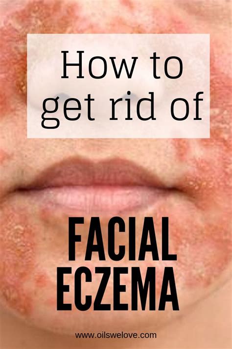 40 Natural Eczema Treatments & Remedies in 2020 | Natural eczema ...