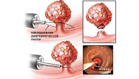 Полип в носу: удалять или нет и нужно ли это?