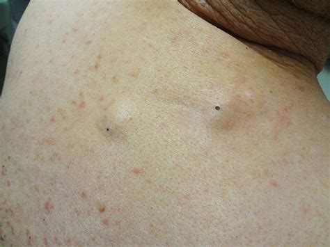 Skin Cyst On Back
