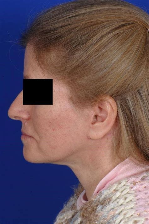 patient  facelift    matthew bridges md