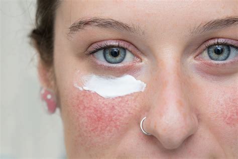 What Are The Best Products for Rosacea? Here’s Everything You Need to Know