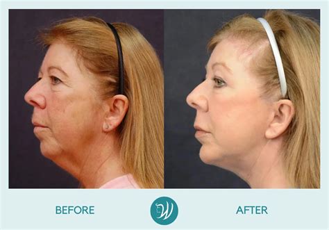 Indianapolis Skin Resurfacing Before & After Photos | Winslow Facial ...