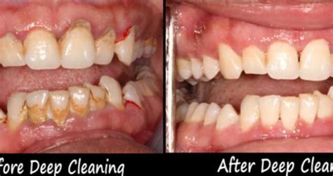 Deep Cleaning Process – Dentist Near Me Dental Office in Hayward & Milpitas