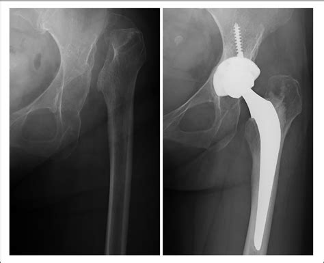 figure     anterior total hip arthroplasty reduction technique