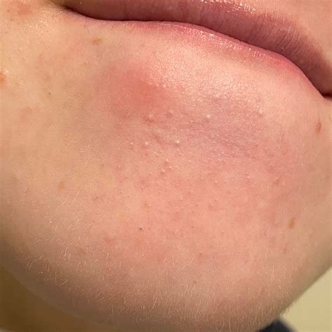 closed comedones (CC) : r/SkincareAddicts